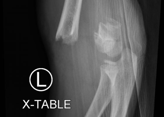 Pediatric Supracondylar Fracture 12 Creative Commons images