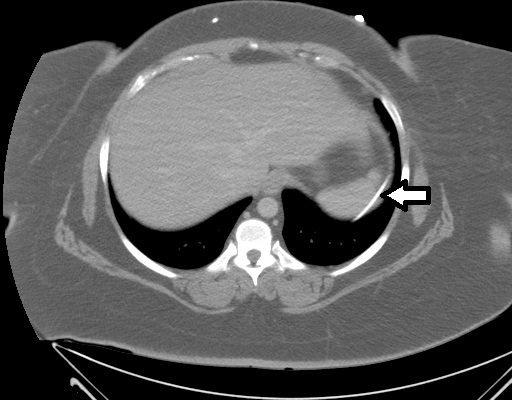 Ventriculoperitoneal Shunt Migration 12 Creative Commons images