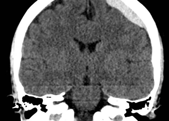 Acute Subdural Hematoma 2 Creative Commons images