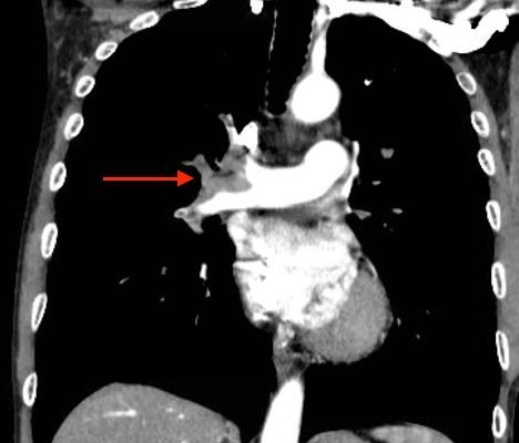 Acute, massive pulmonary embolism with right heart strain and hypoxia requiring emergent tissue plasminogen activator (TPA) infusion 8 Creative Commons images