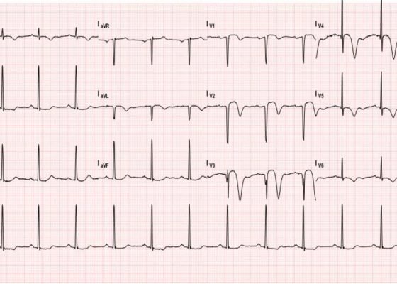 Wellens’ Sign (Wellens’ Syndrome) 2 Creative Commons images