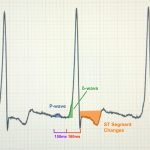 Asymptomatic Wolff-Parkinson-White Syndrome: Incidental EKG 2 Creative Commons images