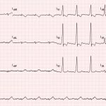 Asymptomatic Wolff-Parkinson-White Syndrome: Incidental EKG 1 Creative Commons images
