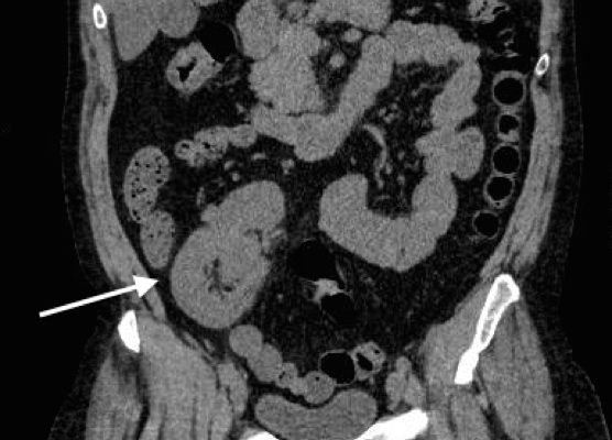 Ectopic Kidney 2 Creative Commons images