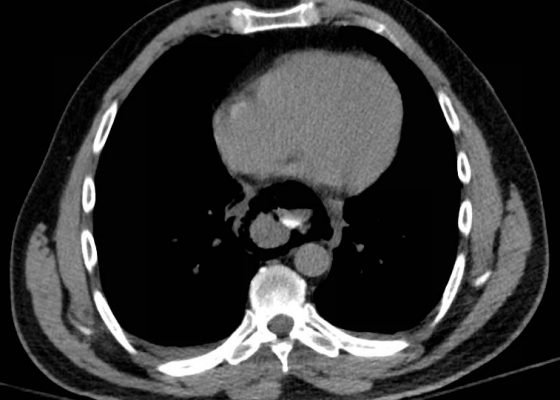 Esophageal Perforation 12 Creative Commons images