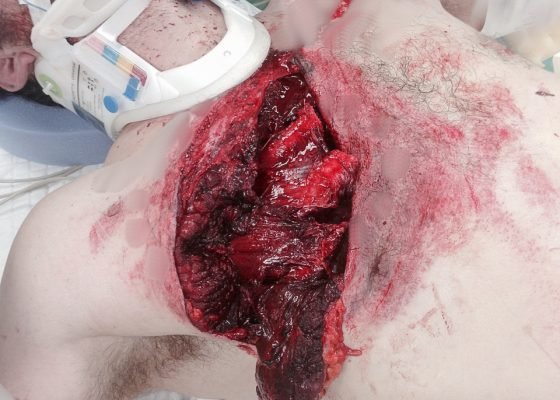 Open Pneumothorax 4 Creative Commons images