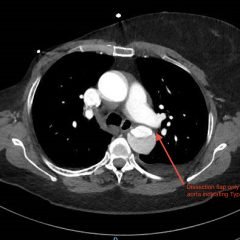 Renal Infarction from Type B Aortic Dissection 5 Creative Commons images