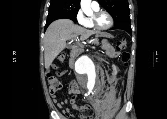 Ruptured Abdominal Aortic Aneurysm 2 Creative Commons images