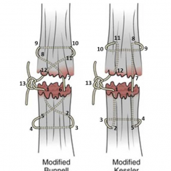 A Simulation Model for Extensor Tendon Repair 2 Creative Commons images