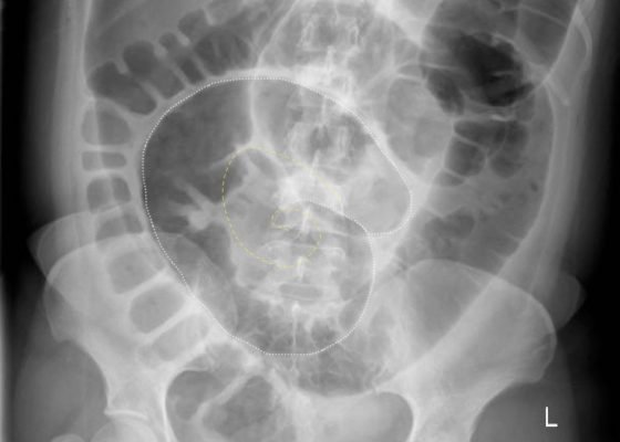 Volvulus 8 Creative Commons images