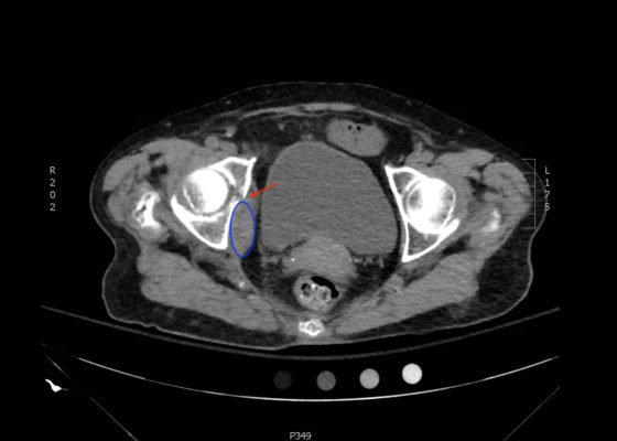 Acetabular Fracture 4 Creative Commons images