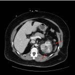 Acute Pyelonephritis with Perinephric Stranding on CT 1 Creative Commons images