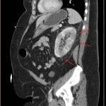 Acute Pyelonephritis with Perinephric Stranding on CT 2 Creative Commons images