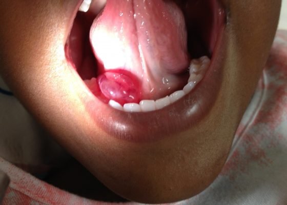 A Sublingual Mass in a 5-Year-Old Male 10 Creative Commons images