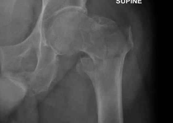 Acute comminuted intertrochanteric hip fracture 8 Creative Commons images