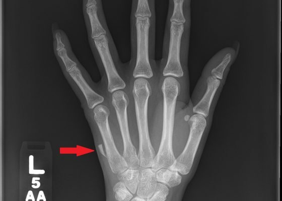 Glass Foreign Body Hand Radiograph 10 Creative Commons images