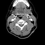 An Unusual Case of Pharyngitis: Herpes Zoster of Cranial Nerves 9, 10, C2, C3 Mimicking a Tumor 4 Creative Commons images