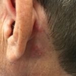 An Unusual Case of Pharyngitis: Herpes Zoster of Cranial Nerves 9, 10, C2, C3 Mimicking a Tumor 1 Creative Commons images