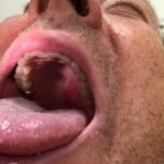 An Unusual Case of Pharyngitis: Herpes Zoster of Cranial Nerves 9, 10, C2, C3 Mimicking a Tumor 3 Creative Commons images