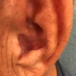 An Unusual Case of Pharyngitis: Herpes Zoster of Cranial Nerves 9, 10, C2, C3 Mimicking a Tumor 2 Creative Commons images