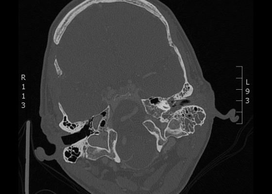 A Case of Otomastoiditis 8 Creative Commons images