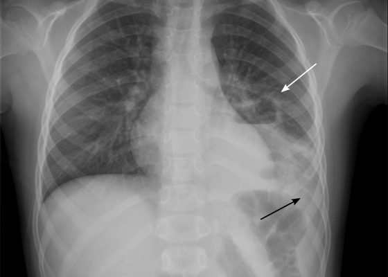 Pediatric Pulmonary Abscess 4 Creative Commons images