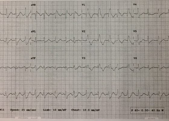 Propafenone Overdose-induced Arrhythmia and Subsequent Correction After Administration of Sodium Bicarbonate 2 Creative Commons images