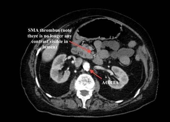 Elderly female with acute abdominal pain presenting with Superior Mesenteric Artery Thrombus 2 Creative Commons images