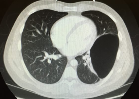 Bullous Emphysema 8 Creative Commons images