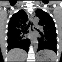 Acute Dysphagia in a 25-Year-Old Male 9 Creative Commons images