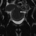 A Rare Cause of Pelvic Pain in a Teenage Girl 1 Creative Commons images