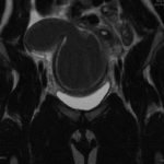 A Rare Cause of Pelvic Pain in a Teenage Girl 4 Creative Commons images