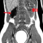 A Rare Cause of Pelvic Pain in a Teenage Girl 2 Creative Commons images
