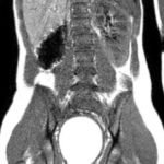 A Rare Cause of Pelvic Pain in a Teenage Girl 5 Creative Commons images