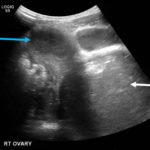 A Rare Cause of Pelvic Pain in a Teenage Girl 3 Creative Commons images