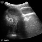 A Rare Cause of Pelvic Pain in a Teenage Girl 6 Creative Commons images