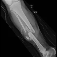 Bilateral Tibia/Fibula Fractures in Automobile versus Pedestrian Accident 10 Creative Commons images