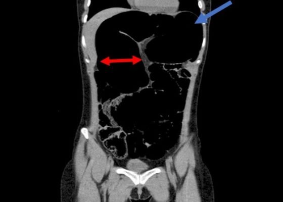 Recurrent Sigmoid Volvulus in a Young Female 16 Creative Commons images