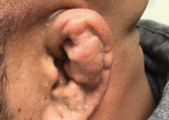 Cauliflower Ear Secondary to a Chronic Auricular Hematoma 12 Creative Commons images