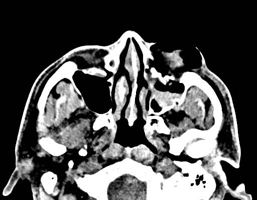 Facial Fracture Induced Periorbital Emphysema 8 Creative Commons images