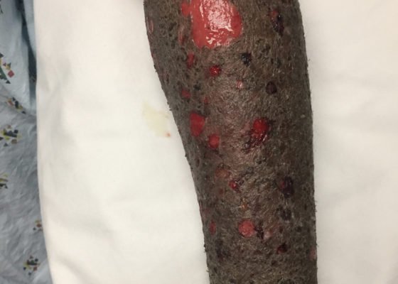 Pemphigoid Gestationis 16 Creative Commons images