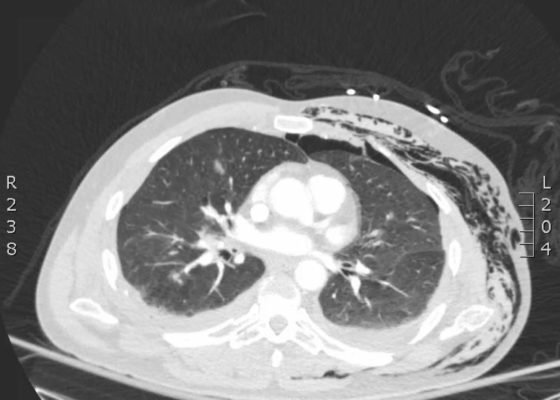Subcutaneous Emphysema After Chest Trauma 6 Creative Commons images