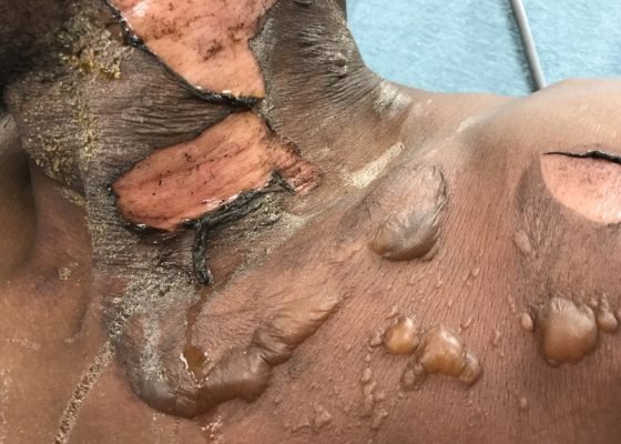 Various Degrees of Thermal Burns 14 Creative Commons images