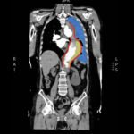 Intramural Hematoma with Type B Aortic Dissection 1 Creative Commons images