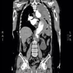 Intramural Hematoma with Type B Aortic Dissection 2 Creative Commons images