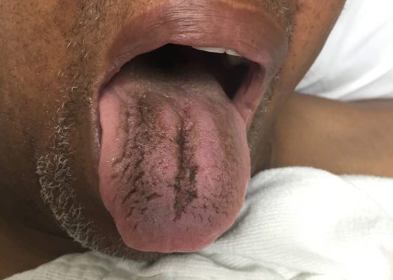 Abdominal Pain with Black Tongue 6 Creative Commons images