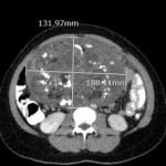Ovarian Teratoma 4 Creative Commons images