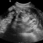 Ovarian Teratoma 5 Creative Commons images