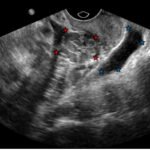 Ovarian Teratoma 3 Creative Commons images