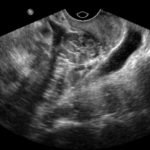 Ovarian Teratoma 6 Creative Commons images